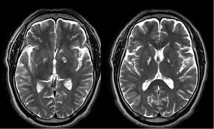 뇌자기공명영상 (brain magnetic resonance imaging, MRI) 에서양쪽담창구에 T2강조영상에서고신호강도, T1강조영상에서저신호강도의병변을보였으며 (Fig.