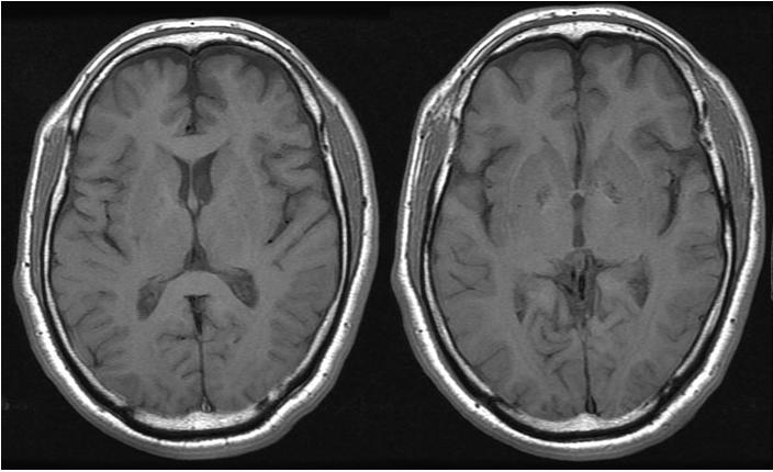 고산등반이후발생한인지기능장애 A B C Figure 2. Follow up brain MRI and SPECT findings (10 month after the onset of symptoms).