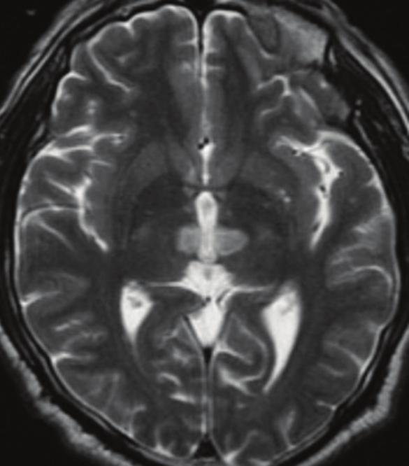 FIGURE 1. Brain MRI of the patient.