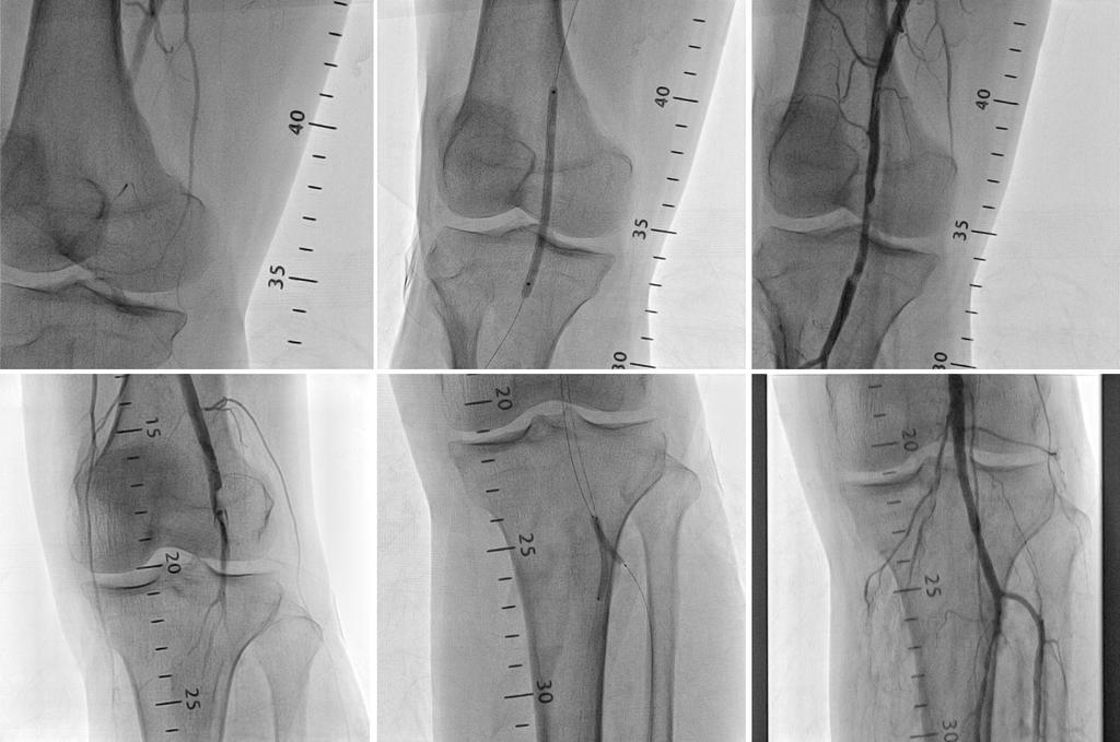 Soo Hyung Park, et al. Endovascular therapy for bilateral popliteal thromboembolism Figure 2.