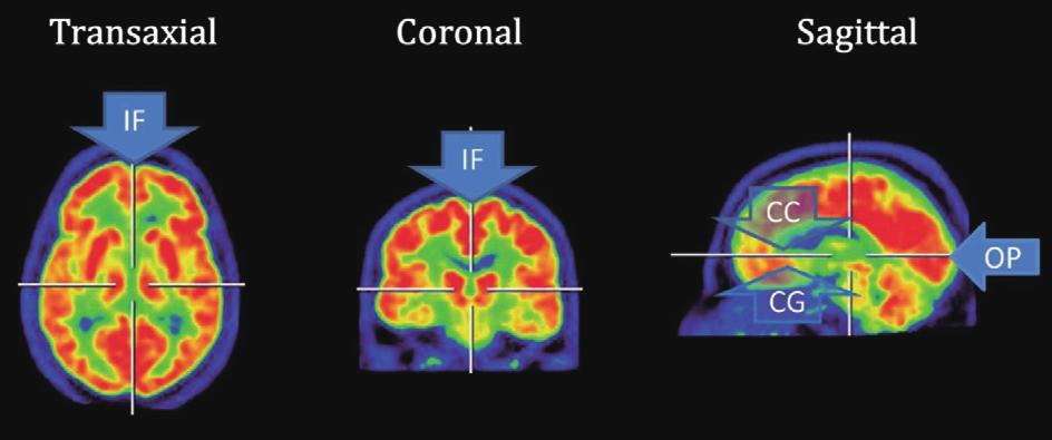 J Korean Neuropsychiatr Assoc 2018;57(1):12-22 선행한다는 점에서 기능적 뇌 영상 검사는 조기 진단 및 치료 에서 임상적인 중요성을 가진다 또한 는 기능적 뇌 영상 검사 중에서도 알츠하이머병에 대한 높은 진단적 정 확도와 예후예측도를 보이는 것으로 보고되고 있다 이와 같 은 추적자는 백질보다 피질에서 더 많이 흡수되며