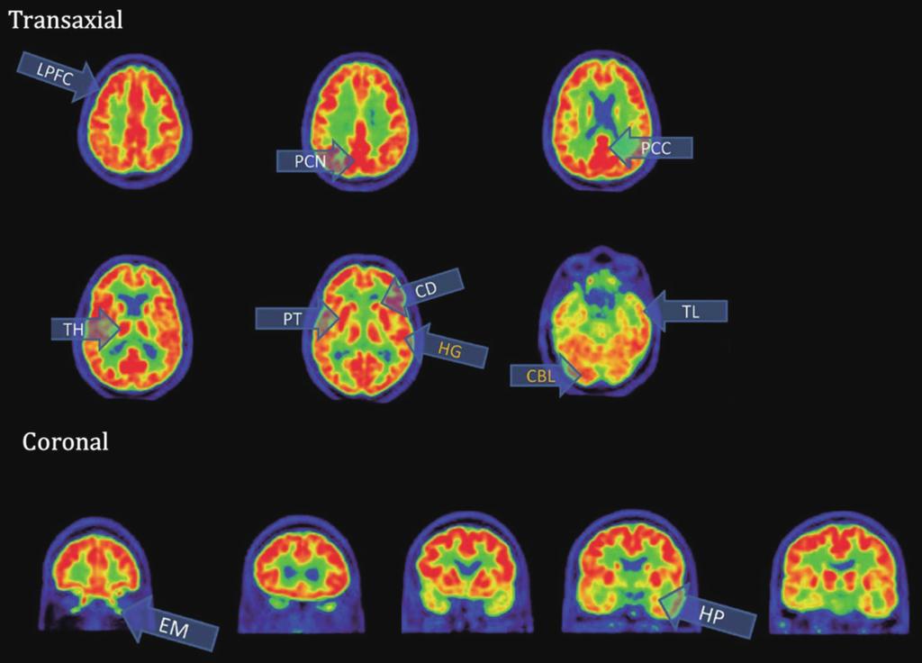 양전자방출단층촬영영상의정상소견 의 뇌 영상은 시각적으로 평가하기 적합하도록 컬러 척도가 조정이 되어야 한다 반구간 틈새 - 후두엽 뇌랑 - 띠이랑 의 영역이 시각 기반 평가를 위 A B Fig. 5. Normal 18 F-fludeoxyglucose positron emission tomography scans.