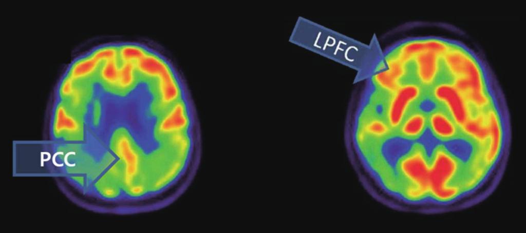 B : Orthogonal scans displaying reduced metabolism in right posterior cingulate cortex in mild cognitive impairment patient.