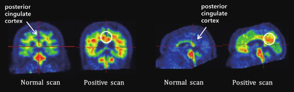 뇌 위축으로 인한 영향을 최소화 하기 때문에 알츠하이머병의 치료 및 질환 경과 수정의 주 하기 위해서 전두극(frontal pole) 근처에서 관찰하는 것이 정 요 목표가 된다. 인지기능이 정상인 고령군의 1/3에서 아밀로 확하다.