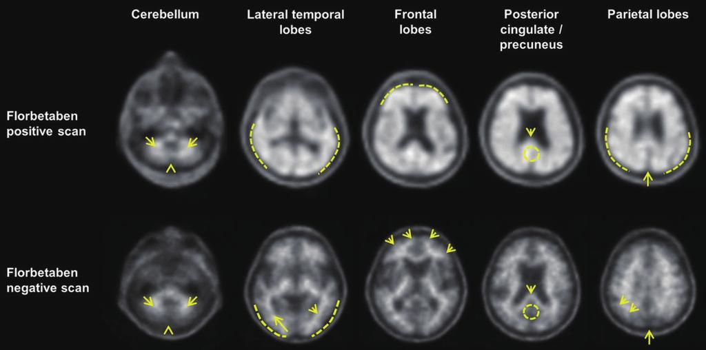 알츠하이머병과뇌영상검사 DW Kang and HK Lim 관찰하였을 때 뇌량의 후측과 백질의 연결 부위 위쪽에서 이하의 강도인 푸른색 컬러 척도로 관찰되고 관상면에서 관찰하였을 때에는 십자가 모양의 푸른색 컬러 척도로 관찰된다 시상면에서 관찰되는 양성 스캔은 뇌량의 후측과 백질이 만나는 지점에서 높은 강도의 흡수를 보이고 관상면에서 관찰되는 양성 스캔은