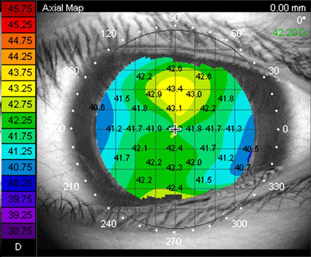 fter 1 month of wearing spherical orthokeratology lens, both eyes (: right eye, : left eye) show nasally flattened cornea on