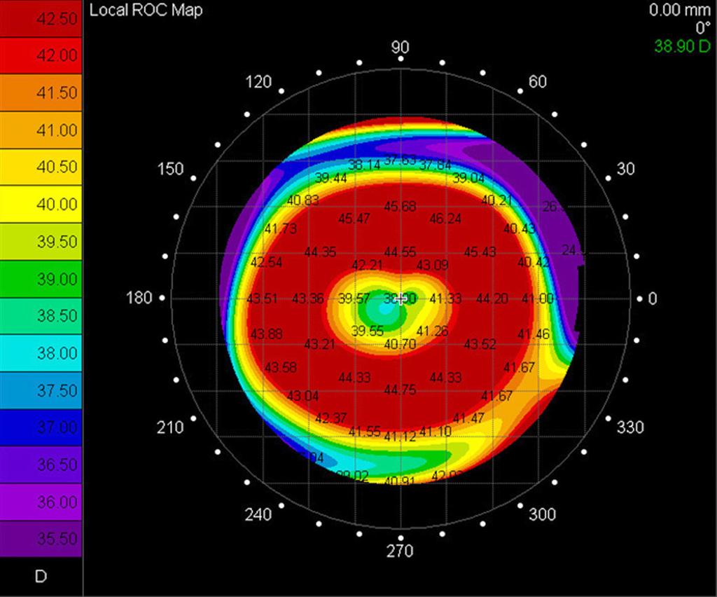 - 대한안과학회지 2013 년제 54 권제 3 호 - Figure 3. fter 12 months of wearing toric orthokeratology lenses, both eyes (: right eye, : left eye) show well-centered bull s eye pattern on topography.