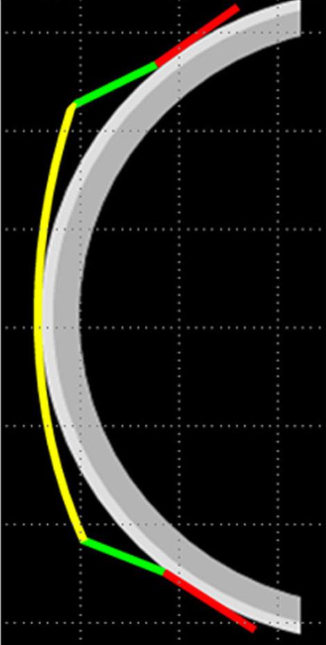 with limbus to limbus astigmatism (yellow colors; optic zone, green colors; reverse curves).