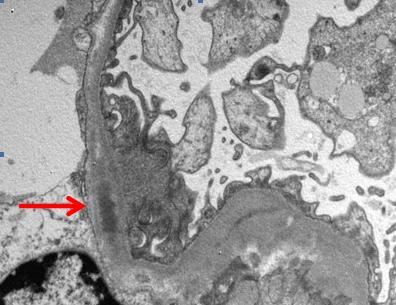 - 대한내과학회지 : 제 78 권제 6 호통권제 598 호 2010 - Figure 3. Electron microscopy shows that most of the glomerular basement membranes are irregularly thickened and markedly folded.