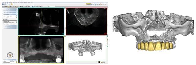 정확한보철물이식및고난도수술성공 자료 : 강남세브란스치과병원임플란트클리닉 (2013), Materialise Dental(2013).