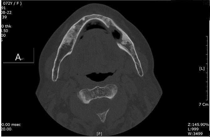 Sujin Lee, et al:a Case of Intractable Bisphosphonate-Related Osteonecrosis of the Jaw Treated with Teriparatide 증례 72세여자환자로좌측하악구치부통증을주소로 2008년 4월구강악안면외과에내원하였다.