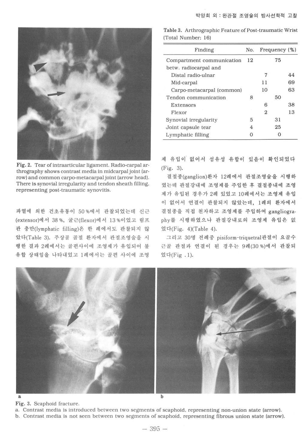 박양희외 j 완관절조영술의방사선학적고칠 Table 3. Arthrographic Feature of Post-traumatic Wrist (Total Number: 16) Finding No Frequency (%) Compartment communication 12 75 betw.