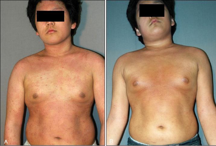 Phototherapy Ann Dermatol 2010;22:1-8 Atopic dermatitis lesions (A) before