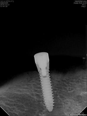 7. Radiographs on 3 months after implant placement and