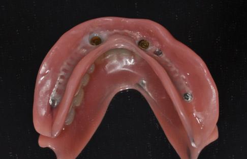 patient was satisfied with both dentures with function and acceptable