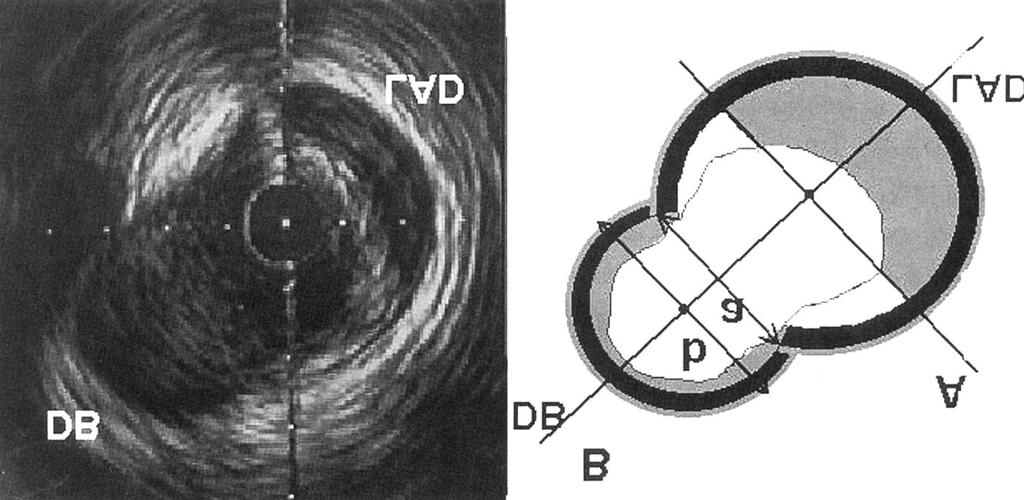 IVUS analysis at ea