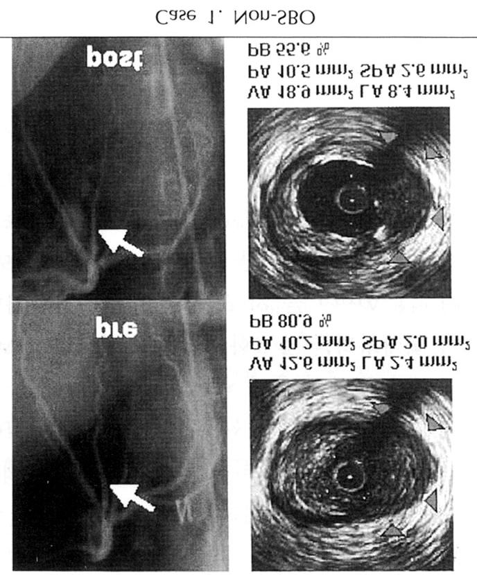 본연구의주요결과및의의 분지의혈관내초음파검사 Fig. 6.