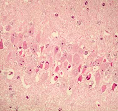 310 박혜진 구혜수 한운섭외 1 인 A B Fig. 1. Neuronal changes seen in 10-min bilateral global ischemia with reperfusion for 24 hour in D3 injected experimental group.