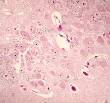 Number of animals with histological grading of the damage in hippocampal neurons at 1 day following bilateral common carotid artery ligation Sub-CA1: subiculum-ca1. *: p=0.065, **: p=0.074.