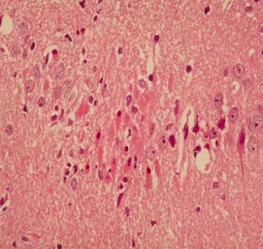 해마의지연성신경세포손상에대한 Calcitriol 의영향 311 A B Fig. 2. Neuronal changes seen in 10-min bilateral global ischemia with reperfusion for 3 days in D3 injected experimental group.