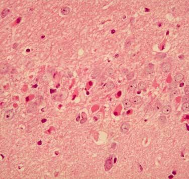 Number of animals with histological grading of damage in hippocampal neurons at 7 days following bilateral common carotid artery ligation None (0) Mild (1+) Moderate (2+) Severe (3+) Saline (n=8)