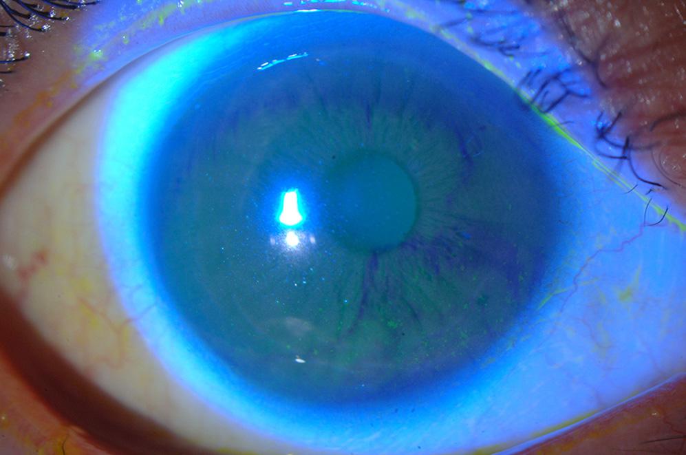inferior halves of the cornea in