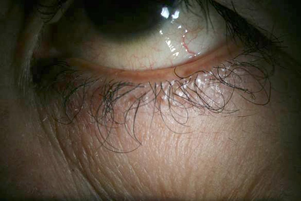 (A) Eighty-two-year-old female patient under chemotherapy with gefitinib for metastatic lung cancer shows elongated eyelashes and blepharitis on the upper and lower lids.