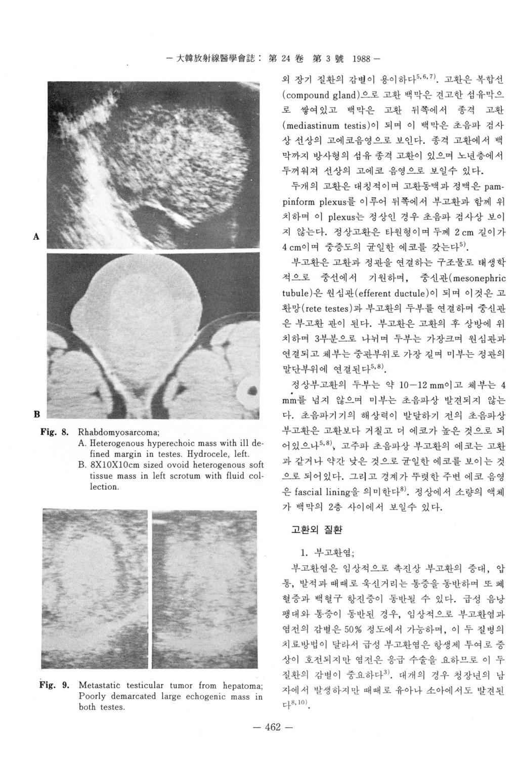 - 大韓放射線題學會誌 第 24 卷第 3 號 1988 - 외장기질환의감벨이용이하다 5, 6, 7) 고환은복합선 (compound gla nd ) 으로고환액막은견고한섬유막 로쌓여있고백막은고환뒤쪽에서종격고환 A B Fig. 8. Rhabdomyosarcoma; A.