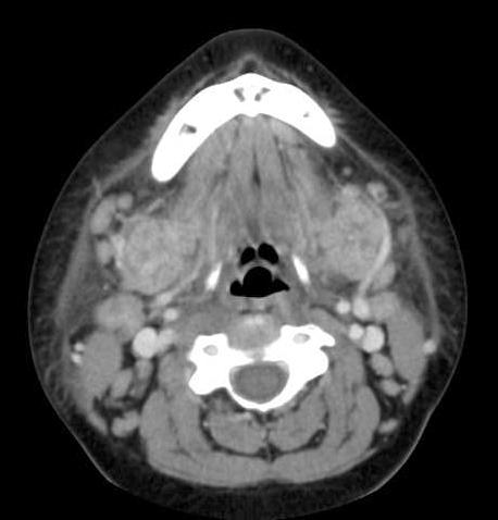 Postcontrast CT shows bilateral globular enlarged submandibular glands with homogeneous enhancement.