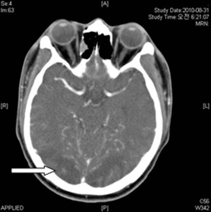 mg/dl, 크레아티닌 4.91 mg/dl, 혈청 potassium 4.3 mmol/l 로호전되어혈액투석치료를중단하였다. 입원 26일 째시행한추적뇌자기공명영상검사상뇌부종소견소실되었 으며 (Fig. 3B) 전신상태호전되어입원 30 일째퇴원하였다. 퇴원 는 1개월후외래추적관찰중시행한혈청크레아티닌수치 1.01 mg/dl 로정상소견보였다. 고 찰 Fig. 2. Brain angiography CT performed after seizure shows low density lesion on bilateral posterior cerebral artery territory.