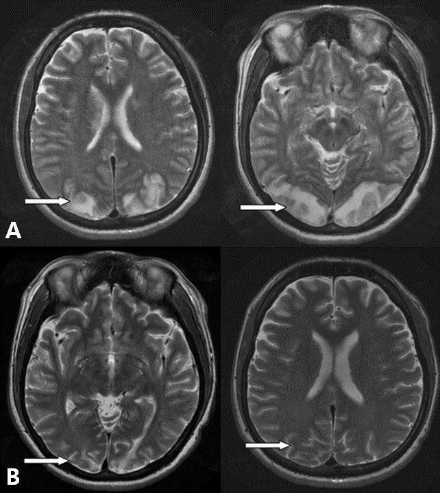 (A) T2 weighted MR image performed 1 day after seizure shows bilateral patchy increased signal intensity with gyral swelling in both cerebellar hemisphere, parieto-occipital cortex and subcortical