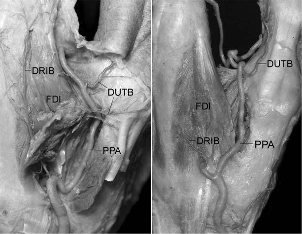 128 허미선, 한희돈, 곽현호, 허경석, 이규석, 김희진 a b Fig. 4. Locational relationship of the princeps pollicis artery (PPA) with the first dorsal interosseous muscle (FDI).