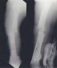 (B) After our debridement, we applied temporary skeletal traction with implantation of antibiotics -impregnated cement