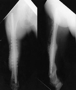 (D) Radiographs at two years later after the first stage procedure showed successful union. 우 ) 으로평가하였다.