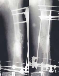 A 29-year-old male had undertaken external fixation for comminuted open fracture of femoral midshaft after driver's traffic accident, which resulted in nonunion and chronic osteomyelitis with