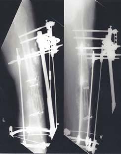 (C) Microvascularized double-barrel fibular transfer was performed two months later. (D) Radiographs after 26 months showed bony union. 상부절단을시행했고, 나머지한예는자의퇴원한후추시되지않았다.