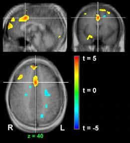 (ACC), SMA, inferior temporal cortex, 그리고 occipital lobe 등에서뇌활성화를보였다.