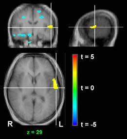 88 2005 마약류퇴치심포지엄 (a) 2D condition: anterior cingulate gyrus & left superior temporal gyrus (b) 3D condition: right superior fontal <2D와3D 조건에서의뇌활성화영역 > 3D 즉가상환경조건에서는가상의술집에노출된뇌활성화영역에서대