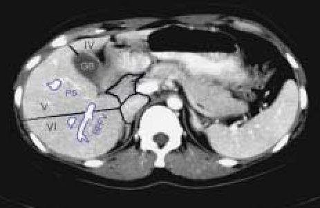 나 ) 역동적 CT(3 or 4 phase) (1) 조영전, 조영제의정맥주입후동맥기, 문맥기, 지연기의영상을얻어조영양상비교 (2) 간세포암의특징적소견 : 동맥기조영증강, 지연기조영소실 (3)