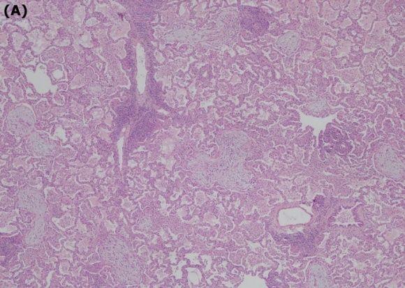이은지등 : 단일결절양상의폐쇄성세기관지기질화폐렴 Fig. 3. (A) The biopsy specimen showed aninflammation in the surrounding alveoli, with thickening alveolar walls with lymphoid cell infiltration (H&E, 00).