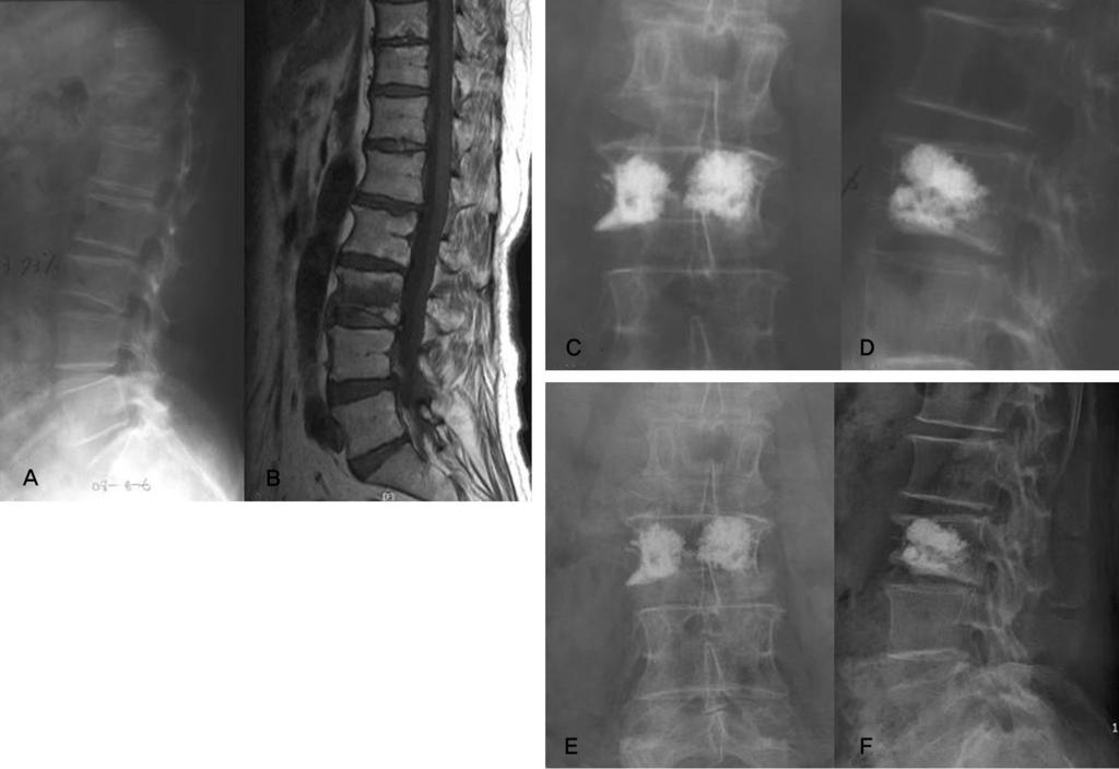 Journal of Korean Society of Spine Surgery Lower-pressure Percutaneous Vertebroplasty Fig. 1. LP-PVP. (A,B) L3 compression fracture was happened in 81-year old female patient.