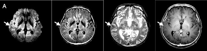 Figure 2. (A) At admission, MRI shows cortical hyperintensity and subcortical hypointensity (white arrows) in Rt.