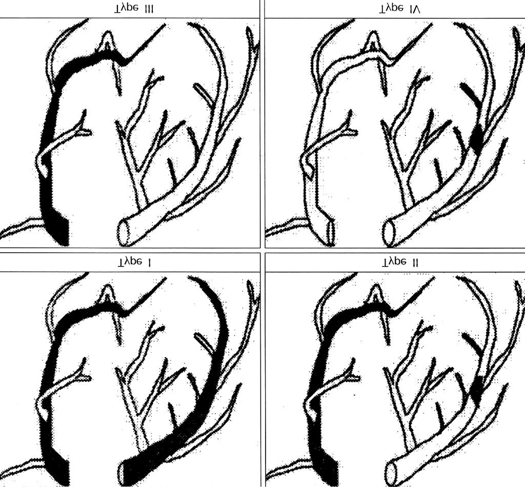 대상및방법 관찰대상 관상동맥확장증의정의및분류 방법 Fig. 1. Markis classfication for coronary artery ectasia. Reprinted Sorrell VL et al.