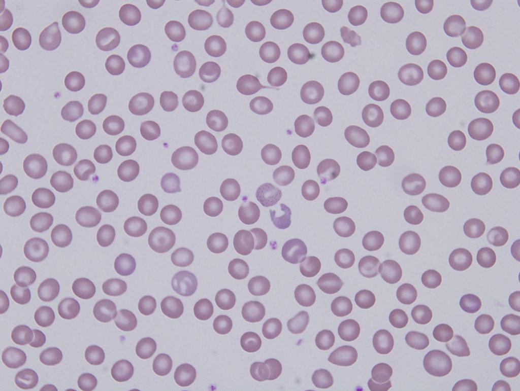대한내과학회지: 제 79 권 제 4 호 통권 제 602 호 2010 A B C D Figure 2. (A) Peripheral blood smear showed polychromasia and red cells with basophilic stippling (Wright stain, 1,000).