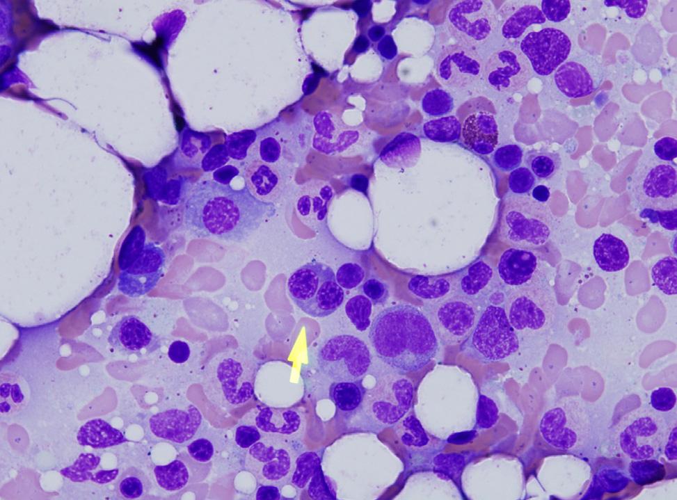 The bone marrow aspirate showed features of dyserythropoiesis with (C) binucleation and (D) lobulated nuclei (Wright stain, 1,000).