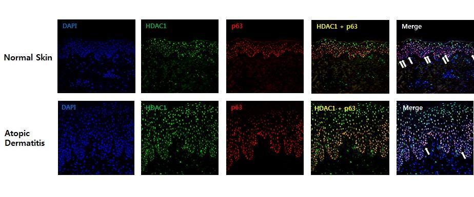 Figure 5. HDAC1 and p63 expressions in normal skin and atopic dermatitis.