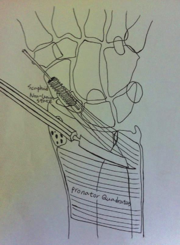 J Korean Soc Surg Hand Vol. 17, No. 4, December 2012 방형회내근유경골편을이용한골이식술에대한보고는적다. 이에저자들은주상골불유합의치료에방형회내근유경골편이식술을이용한치료결과를분석평가하였다. 대상및방법 1.