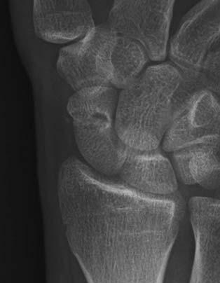 J Korean Soc Surg Hand Vol. 17, No. 4, December 2012 Fig. 2. A 21-year-old man underwent the osteosynthesis using pronator quadratus pedicled bone grafting.