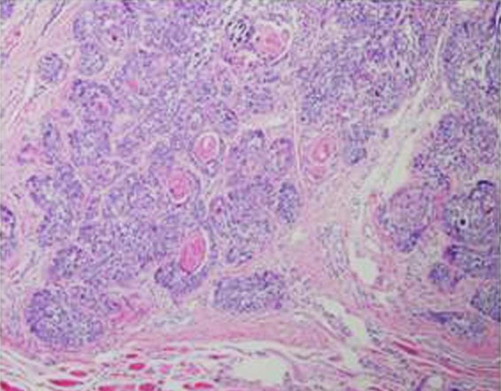 - 염혜리외 : 눈꺼풀바닥편평세포암 1 예 - A B Figure 3. Hematoxylin and eosin staining of the excised lesion. (A) Low magnification view exhibits squamous differentiation in center of some nodules (arrow).