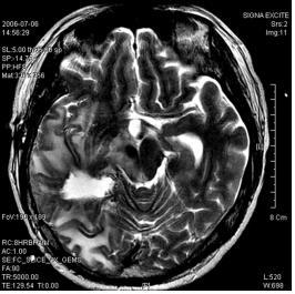 (78) Journal of Korean Medicine 2018;39(1) Fig. 2. Brain MRI Suspicious of Recurrence (2005. 11.17) Fig. 4. Brain MRI after the Second Surgery (2006.07.06) Fig. 3. Brain MRI (2006. 06.